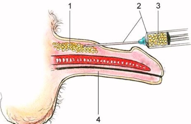 agrandamiento del pene por inyección