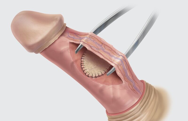 cirugia de agrandamiento del pene