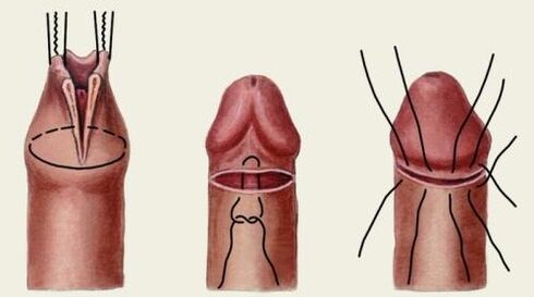 ¿Cómo se realiza la cirugía plástica de pene